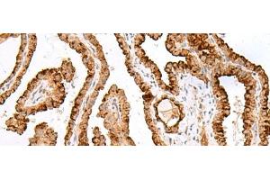 Immunohistochemistry of paraffin-embedded Human thyroid cancer tissue using SAXO2 Polyclonal Antibody at dilution of 1:40(x200) (FAM154B 抗体)