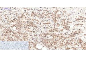 Immunohistochemistry of paraffin-embedded Human breast cancer tissue using LTF Monoclonal Antibody at dilution of 1:200. (Lactoferrin 抗体)