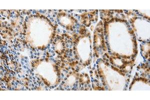 Immunohistochemistry of paraffin-embedded Human thyroid cancer tissue using SELENOS Polyclonal Antibody at dilution 1:40 (Selenoprotein S 抗体)