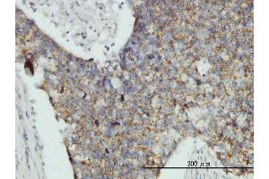 Immunoperoxidase of monoclonal antibody to MRPL12 on formalin-fixed paraffin-embedded human breast cancer tissue. (MRPL12 抗体  (AA 1-198))