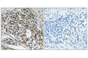 Immunohistochemistry analysis of paraffin-embedded human breast carcinoma tissue using MRPL13 antibody. (MRPL13 抗体  (C-Term))