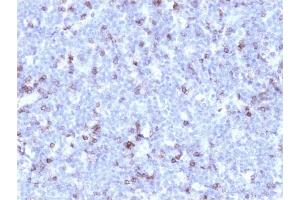 Formalin-fixed, paraffin-embedded human Lymphoma stained with CD43 Mouse Recombinant Monoclonal Antibody (rSPN/1094). (Recombinant CD43 抗体)