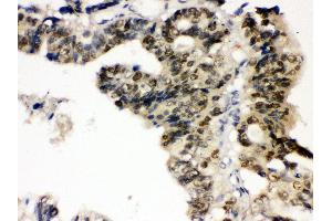 Anti- TCPTP Picoband antibody,IHC(P) IHC(P): Human Intestinal Cancer Tissue (PTPN2 抗体  (AA 1-330))
