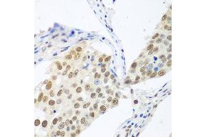Immunohistochemistry of paraffin-embedded human lung cancer using BCAS2 antibody at dilution of 1:100 (40x lens). (BCAS2 抗体)