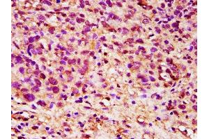 IHC image of ABIN7149816 diluted at 1:200 and staining in paraffin-embedded human ovarian cancer performed on a Leica BondTM system. (DPPA5 抗体  (AA 1-116))