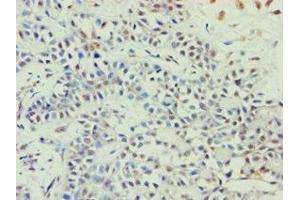 Immunohistochemistry of paraffin-embedded human breast cancer using ABIN7144924 at dilution of 1:100 (ABCE1 抗体  (AA 320-599))
