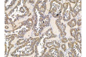 ABIN7095762 and ABIN7099824 at 1/100 staining human ovarian cancer by IHC-P. (ARFGEF1 抗体)