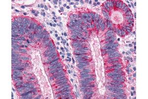 Anti-MCHR1 antibody IHC of human Colon, Carcinoma. (MCHR1 抗体  (N-Term))