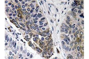 Immunohistochemistry analyzes of IgA antibody in paraffin-embedded human lung carcinoma tissue. (兔 anti-人 IgA Antibody)