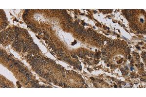 Immunohistochemistry of paraffin-embedded Human colon cancer tissue using ITPR3 Polyclonal Antibody at dilution 1:40 (ITPR3 抗体)