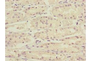 Immunohistochemistry of paraffin-embedded human gastric cancer using ABIN7157720 at dilution of 1:100 (KLF15 抗体  (AA 1-260))