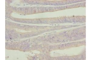 Immunohistochemistry of paraffin-embedded human endometrial cancer using ABIN7174916 at dilution of 1:100 (C9orf43 抗体  (AA 267-461))