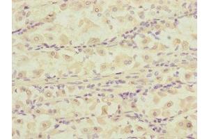 Immunohistochemistry of paraffin-embedded human gastric cancer using ABIN7150823 at dilution of 1:100 (DCTN6 抗体  (AA 1-190))