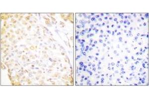 Immunohistochemistry analysis of paraffin-embedded human breast carcinoma, using NKX3. (NKX3-1 抗体  (AA 1-50))