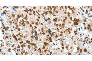 Immunohistochemistry of paraffin-embedded Human esophagus cancer using BNIP1 Polyclonal Antibody at dilution of 1:60 (BNIP1 抗体)