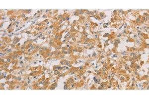 Immunohistochemistry of paraffin-embedded Human thyroid cancer tissue using ZWINT Polyclonal Antibody at dilution 1:50 (ZWINT 抗体)