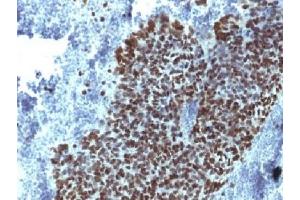 IHC testing of FFPE human prostate carcinoma with FOXA1 antibody (clone FOXA1/1514). (FOXA1 抗体  (AA 372-472))