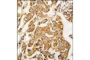 Formalin-fixed and paraffin-embedded human breast carcinoma tissue reacted with IGFBP3 Antibody, which was peroxidase-conjugated to the secondary antibody, followed by DAB staining.