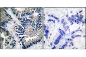 Immunohistochemistry analysis of paraffin-embedded human lung carcinoma tissue, using STAT2 (Ab-690) Antibody. (STAT2 抗体  (AA 656-705))