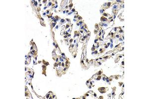 Immunohistochemistry of paraffin-embedded human lung cancer using FIGF antibody at dilution of 1:200 (400x lens). (VEGFD 抗体)