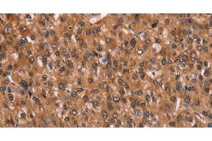 Immunohistochemistry of paraffin-embedded Human liver cancer using HINT1 Polyclonal Antibody at dilution of 1:30 (HINT1 抗体)