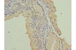 Immunohistochemistry of paraffin-embedded human prostate cancer using ABIN7161717 at dilution of 1:100 (NRARP 抗体  (AA 1-114))