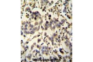 C6orf58 antibody (Center) immunohistochemistry analysis in formalin fixed and paraffin embedded human testis carcinoma followed by peroxidase conjugation of the secondary antibody and DAB staining. (C6ORF58 抗体  (Middle Region))