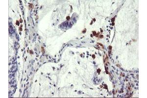 Immunohistochemical staining of paraffin-embedded Adenocarcinoma of Human colon tissue using anti-SDS mouse monoclonal antibody. (serine Dehydratase 抗体)
