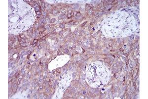 Immunohistochemical analysis of paraffin-embedded cervical cancer tissues using SNAI2 mouse mAb with DAB staining.