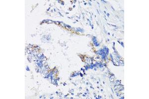 Immunohistochemistry of paraffin-embedded human lung cancer using IKBKE antibody. (IKKi/IKKe 抗体  (AA 495-716))