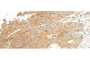 Immunohistochemistry of paraffin-embedded Human colorectal cancer tissue using C5AR2 Polyclonal Antibody at dilution of 1:25(x200) (GPR77 抗体)