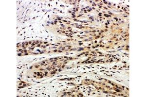 IHC-P: Caspase-14 antibody testing of human esophagus squama cancer tissue (CASP14 抗体  (AA 223-242))