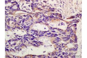 Formalin-fixed and paraffin embedded human rectal carcinoma labeled with Anti-CXCR2/CD182 Polyclonal Antibody, Unconjugated (ABIN732218) at 1:200 followed by conjugation to the secondary antibody and DAB staining (CXCR2 抗体  (AA 316-360))