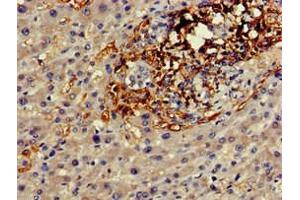 Immunohistochemistry of paraffin-embedded human liver cancer using ABIN7153601 at dilution of 1:100 (GJA8 抗体  (AA 286-432))