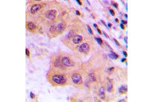 Immunohistochemical analysis of CTPS staining in human liver cancer formalin fixed paraffin embedded tissue section. (CTP Synthase 抗体  (N-Term))