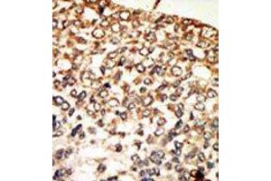 Formalin-fixed and paraffin-embedded human cancer tissue reacted with the primary antibody, which was peroxidase-conjugated to the secondary antibody, followed by AEC staining. (PRKACA 抗体  (N-Term))