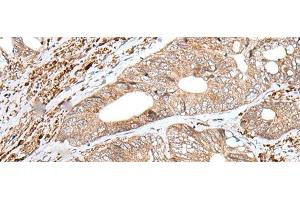 Immunohistochemistry of paraffin-embedded Human colorectal cancer tissue using ENPEP Polyclonal Antibody at dilution of 1:65(x200) (ENPEP 抗体)