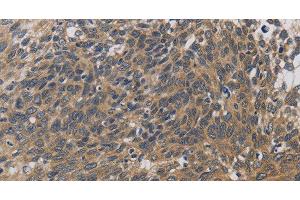 Immunohistochemistry of paraffin-embedded Human cervical cancer using EMC8 Polyclonal Antibody at dilution of 1:30 (COX4NB 抗体)