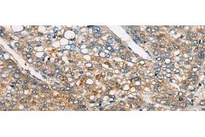 Immunohistochemistry of paraffin-embedded Human liver cancer tissue using CDKL4 Polyclonal Antibody at dilution of 1:45(x200) (CDKL4 抗体)