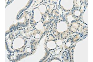 The image on the left is immunohistochemistry of paraffin-embedded Human thyroid cancer tissue using ABIN7192521(SLC7A11 Antibody) at dilution 1/35, on the right is treated with synthetic peptide. (SLC7A11 抗体)