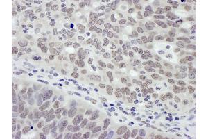 Immunohistochemistry (IHC) image for anti-Metastasis Associated 1 (MTA1) (AA 400-450) antibody (ABIN7454605) (MTA1 抗体  (AA 400-450))