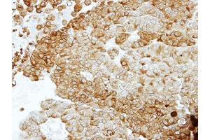 IHC-P Image Immunohistochemical analysis of paraffin-embedded PC14 xenograft, using ENO2, antibody at 1:100 dilution. (ENO2/NSE 抗体)