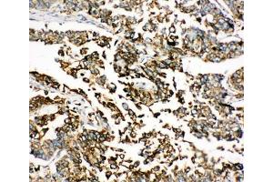 IHC-P: BiP antibody testing of human lung cancer tissue (GRP78 抗体  (C-Term))