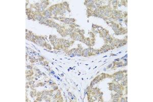Immunohistochemistry of paraffin-embedded human liver cancer using TIMM10B antibody (ABIN5974609) at dilution of 1/100 (40x lens). (TIMM10B 抗体)