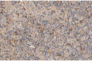 ABIN6267441 at 1/100 staining human Lymphoma tissue sections by IHC-P. (RPS6KB1 抗体  (pSer424))