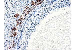 Immunohistochemical staining of paraffin-embedded Adenocarcinoma of Human ovary tissue using anti-ELK3 mouse monoclonal antibody. (ELK3 抗体)