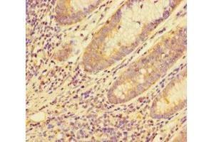 Immunohistochemistry of paraffin-embedded human colon cancer using ABIN7159120 at dilution of 1:100 (MED29 抗体  (AA 1-212))