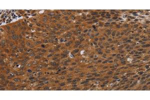 Immunohistochemistry of paraffin-embedded Human cervical cancer tissue using PNOC Polyclonal Antibody at dilution 1:40 (PNOC 抗体)