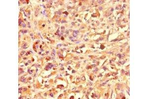 Immunohistochemistry of paraffin-embedded human melanoma using ABIN7155270 at dilution of 1:100 (KAT2B 抗体  (AA 767-832))