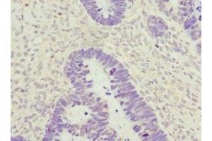 Immunohistochemistry of paraffin-embedded human ovarian cancer using ABIN7176735 at dilution of 1:100 (ZWINT 抗体  (AA 1-277))